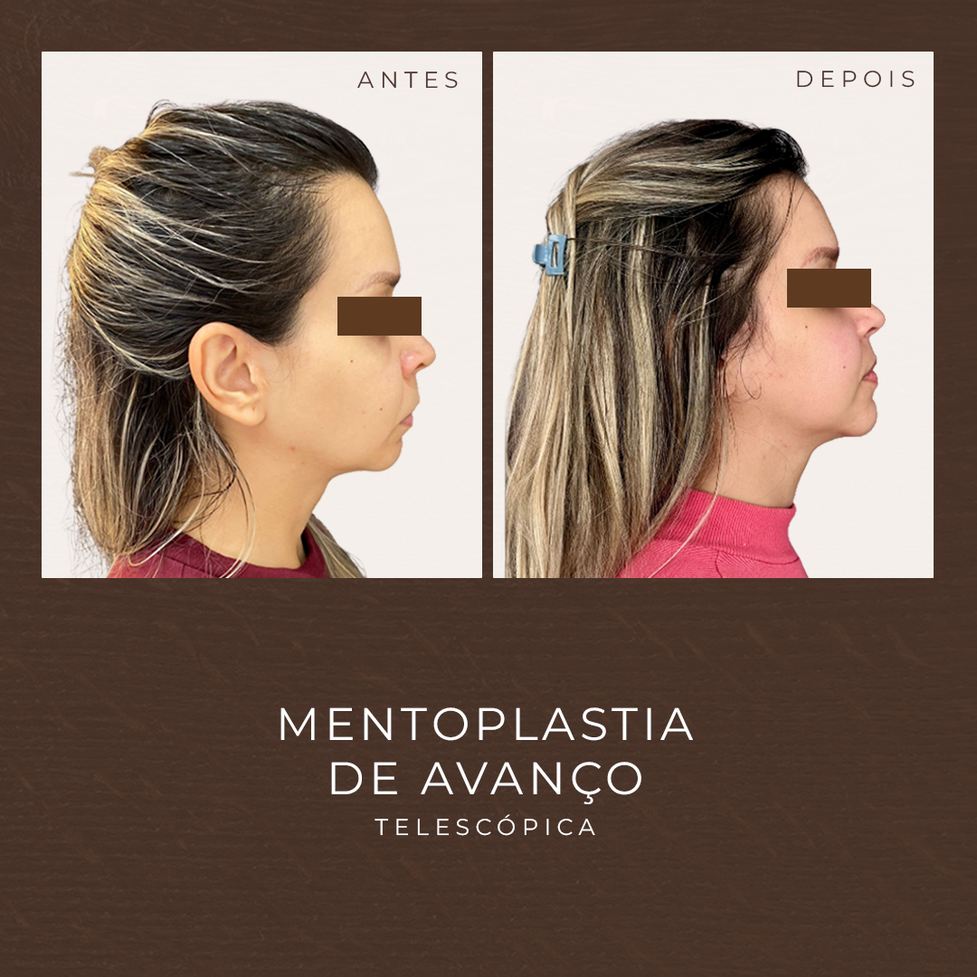 BRUNACAETANO_MENTOPLASTIA1 (1)