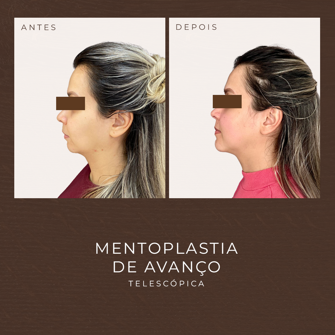 BRUNACAETANO_MENTOPLASTIA2 (1)